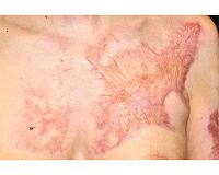 Skin grafts: A look at efforts to save burned volcano victims