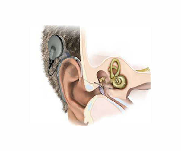 Implantable microphone could lead to fully internal cochlear implants