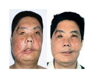 Integrated 3d imaging facilitates human face transplantation