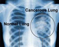 Scientists zero in on how lung cancer spreads