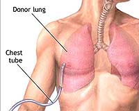 Study; Older transplant patients fare well