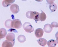 A new way to diagnose malaria