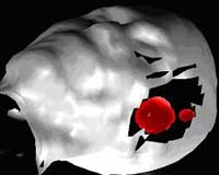 NASA Infrared Camera Helps Surgeons Map Brain Tumors