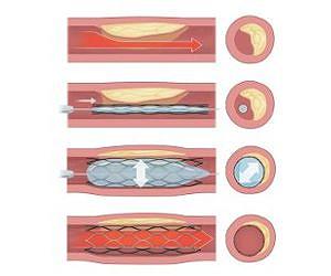 Zinc: The Perfect Material for Bioabsorbable Stents?